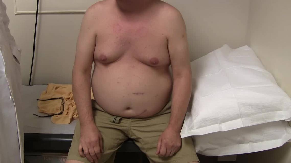 Patient with Severe Pain and Hematoma of the Bicep