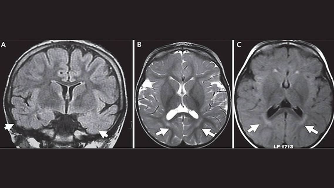Early Onset Drug Resistant Epilepsy Due to Gene Variants