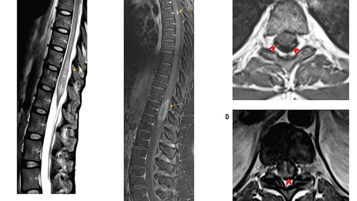 Neuromyelitis Optica Spectrum Disorder With Atypical Imaging Features