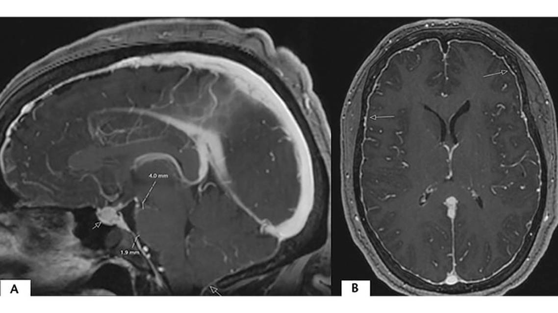 Headache Attributed to Spontaneous Intracranial Hypotension