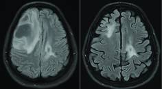 Figure 1 depicting the MRI of a brain