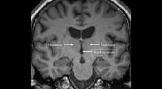 MS Minute Cognitive Dysfunction in People Living with Multiple Sclerosis