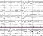 Epilepsy Essentials VideoEEG Analysis