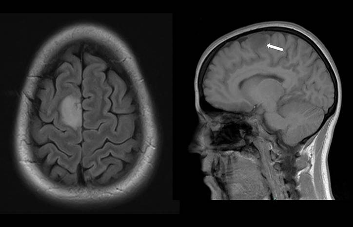 Supplementary Motor Area Glioma Presenting with Musicogenic Epilepsy Singing Seizures