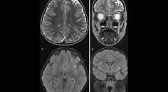 Progressive Drug Resistant Epilepsy and Behavior Changes