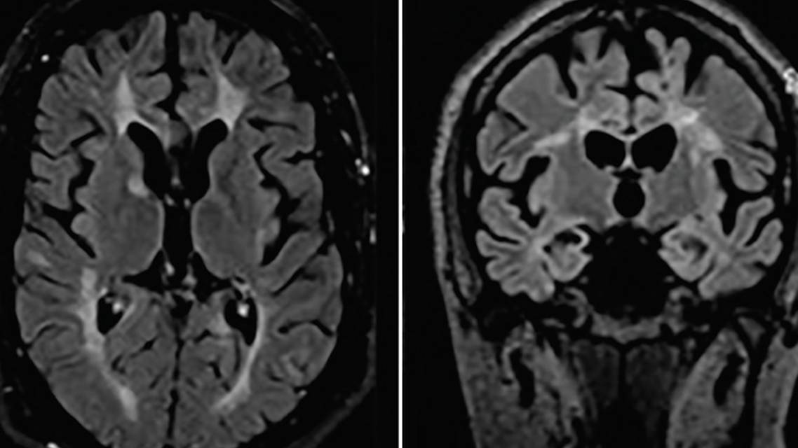 Case Report Hemiparkinsonism in a Patient With Multiple Sclerosis