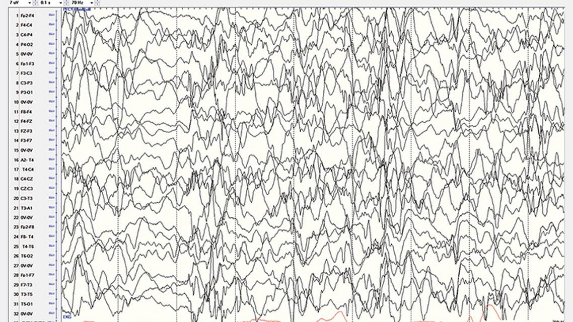 Epilepsy EssentialsInfantile Spasms The Biggest Little Seizures
