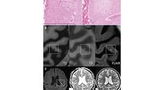 Stroke Snapshot Cerebral MicroinfarctsEtiology and Clinical Implications of This Novel MRI Marker