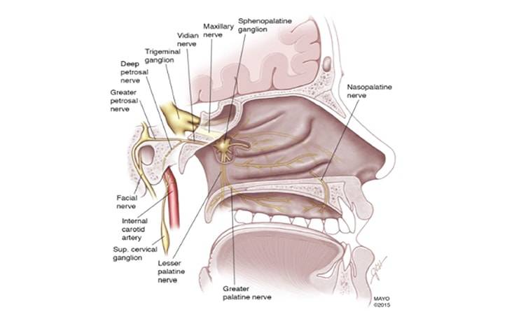 Sphenopalatine Ganglion Block Without Catheter