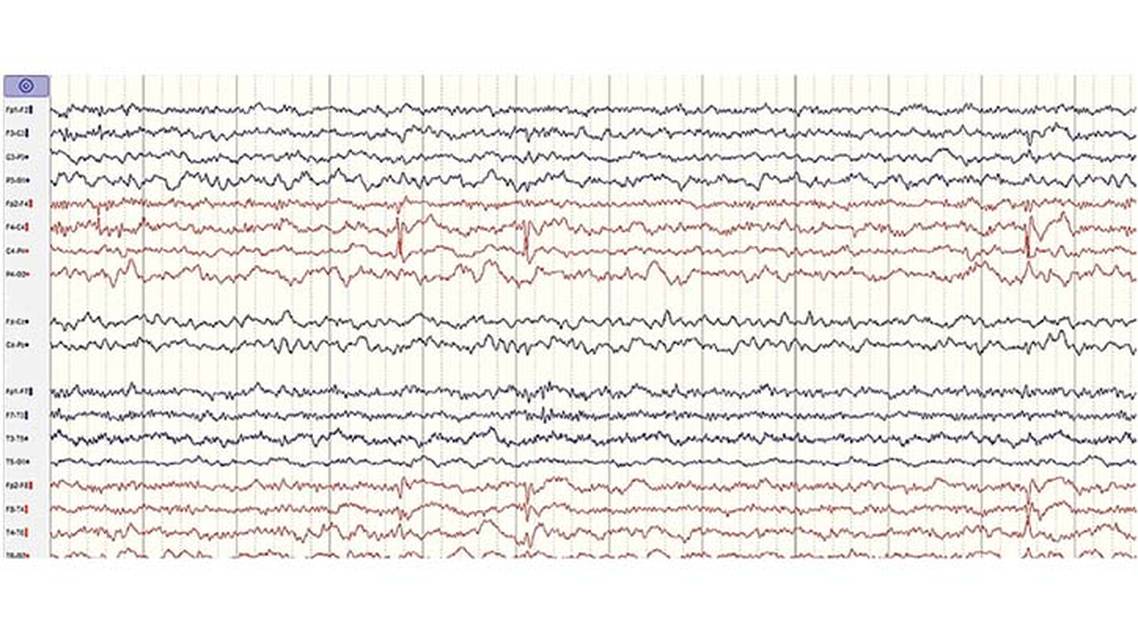Case Report Hyperekplexia and Encephalopathy