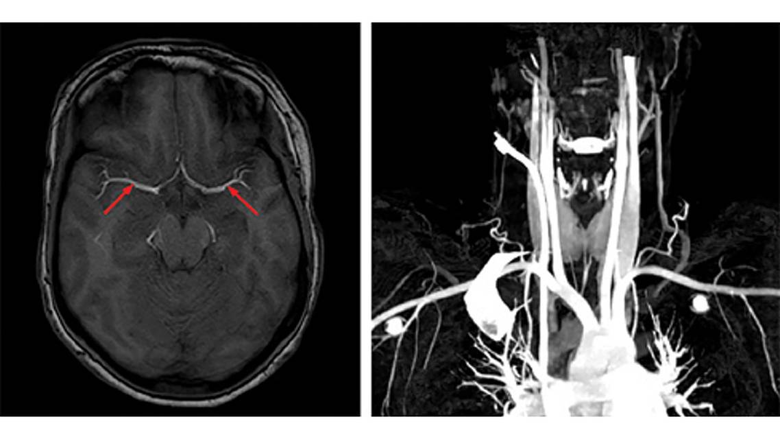 Ischemic Complications from a Facial Lipofilling Procedure