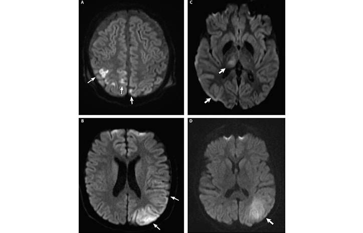 Stroke Snapshot Metabolic Stroke
