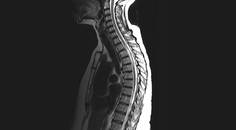 Case Report Longitudinally Extensive Transverse Myelitis