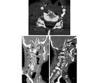 Bilateral Vertebral Artery Dissection and Occlusion After a Long Distance Open Water Swim