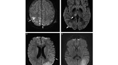 Stroke Snapshot Metabolic Stroke