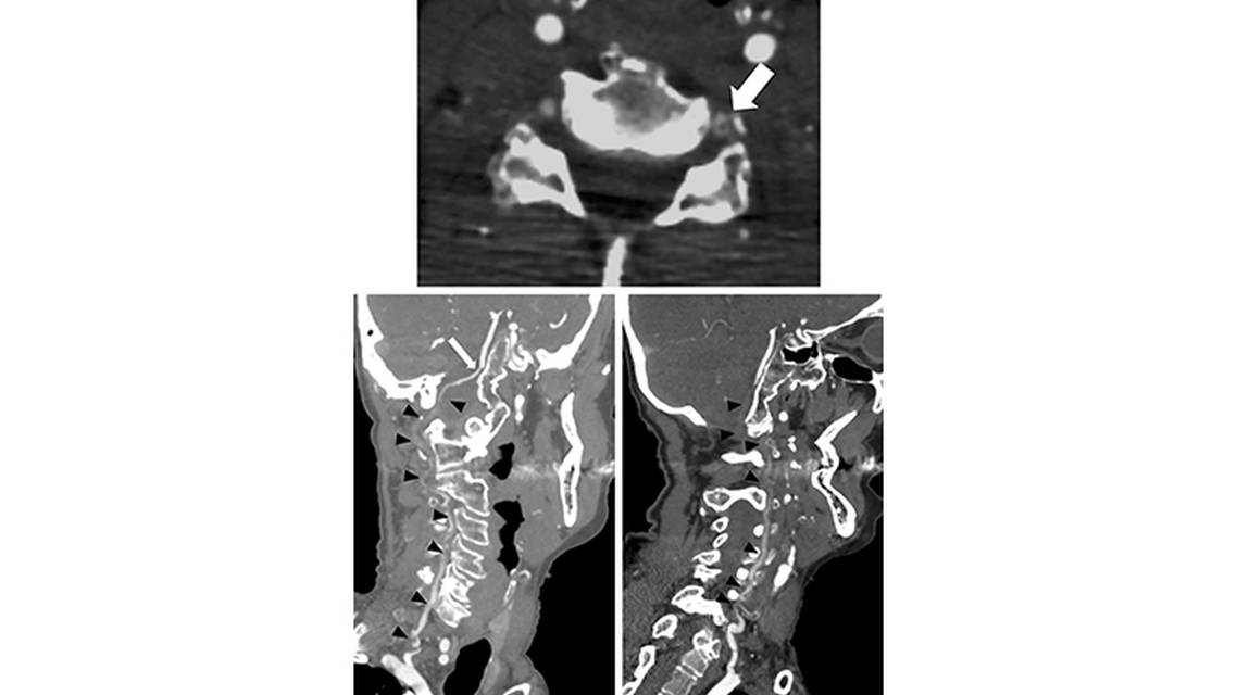 Bilateral Vertebral Artery Dissection and Occlusion After a Long Distance Open Water Swim