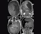 Epilepsy Essentials Hemispherectomy for Early Onset Pediatric Epilepsy A Big Surgery for Small People