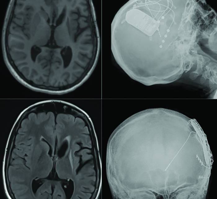 Figure 2 from the article by Fallah and Gallagher in the November 2025 issue of Practical Neurology