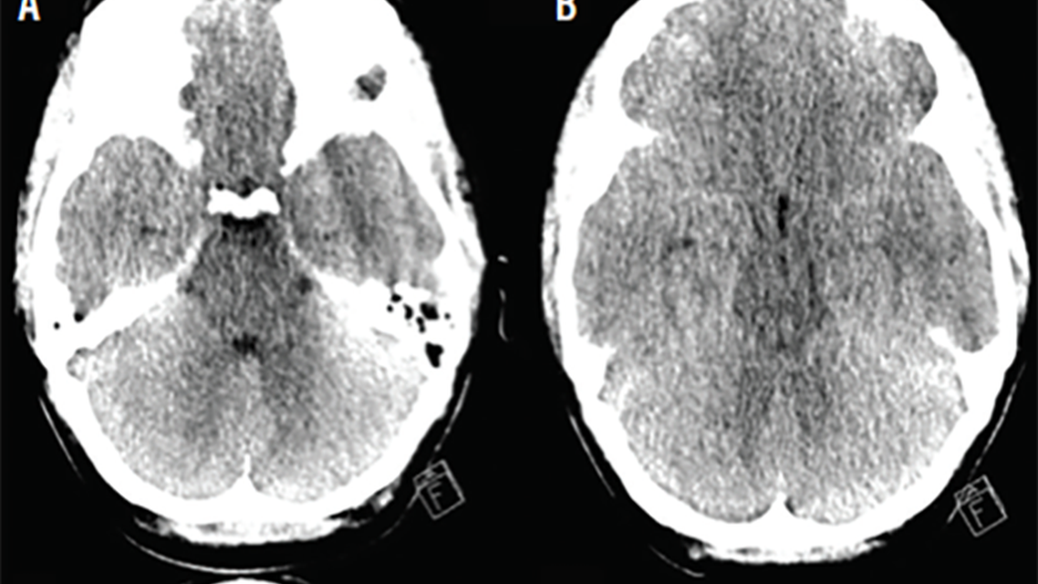 Case Report Noninvasive Intracranial Pressure Monitoring