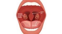 Tonsillectomy for the Treatment of Suspected Sleep Apnea with Subsequent Improvement of Chronic Migraine