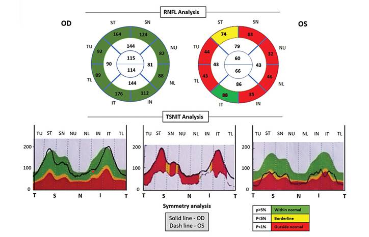 Neuromyelitis Optica Spectrum Disorder in Castleman Disease