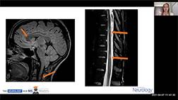 pregnancy and multiple sclerosis thumb new