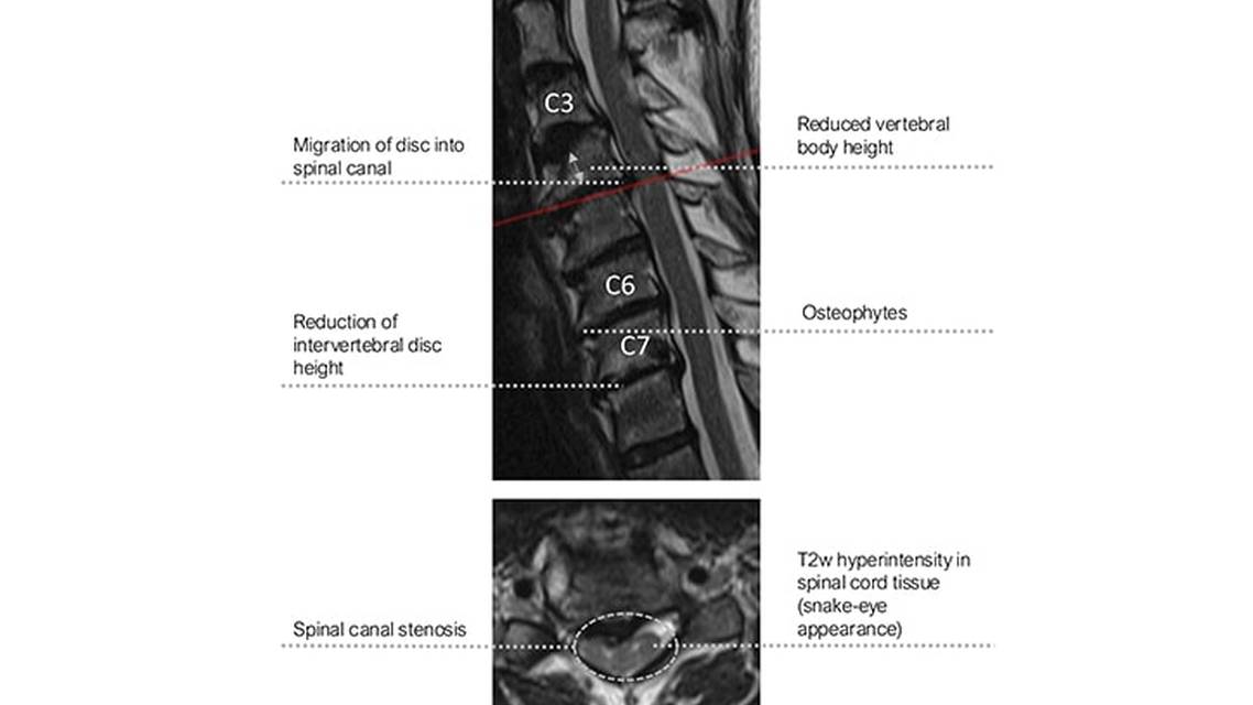 Degenerative Cervical Myelopathy as a Neuromuscular Mimicker