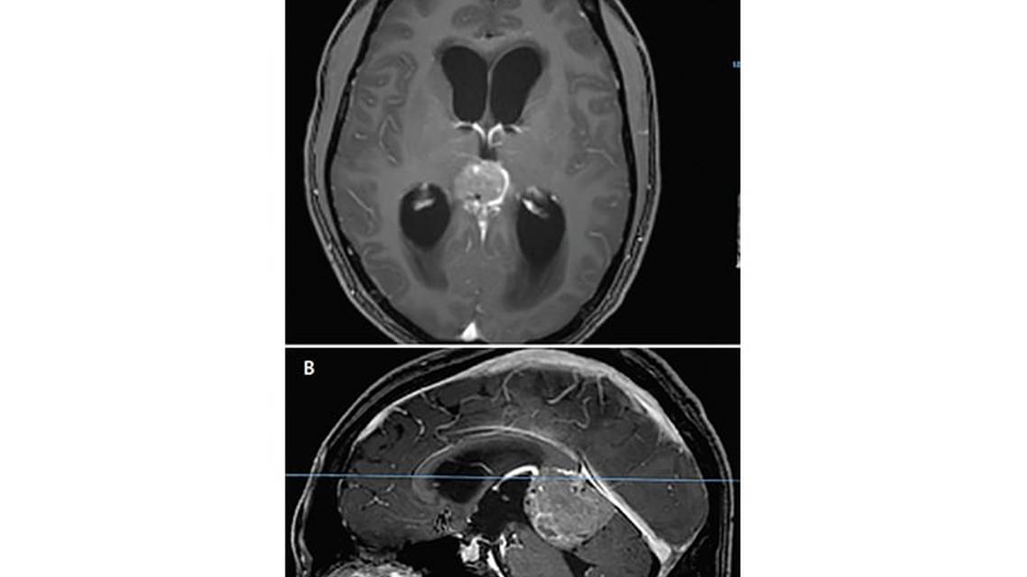 Hearing Loss Associated With Hydrocephalus