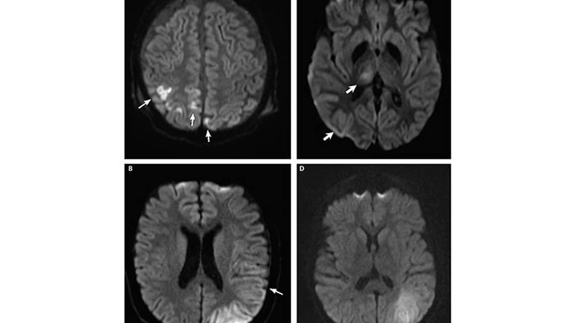 Stroke Snapshot Metabolic Stroke