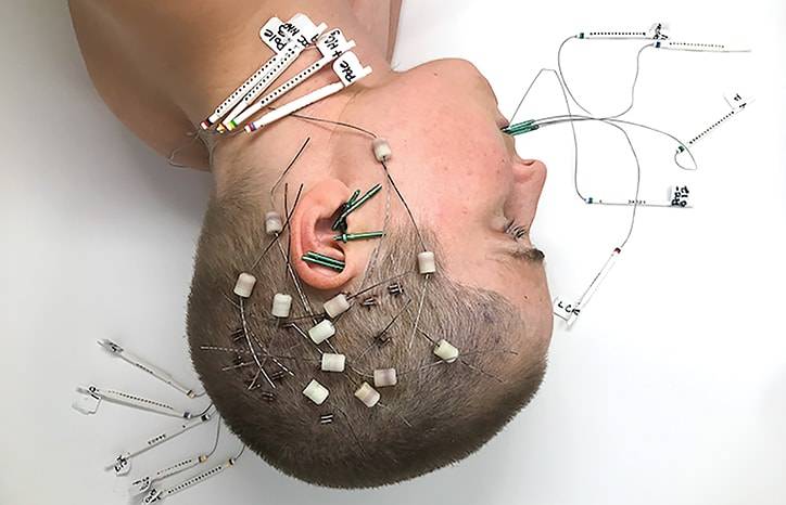 The Many Challenges of Drug Resistant Epilepsy