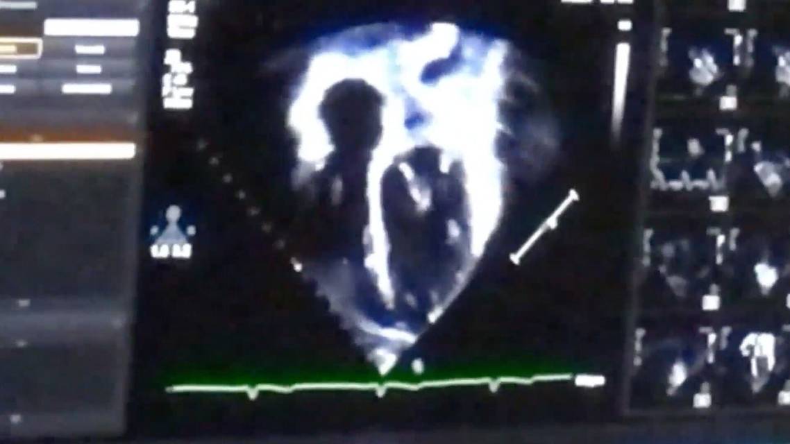 Cardiac Ultrasound thumbnail