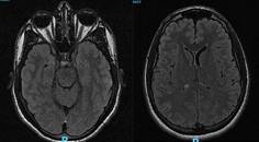 Reversible Cortical Blindness Secondary to Acute Carbon Monoxide Poisoning