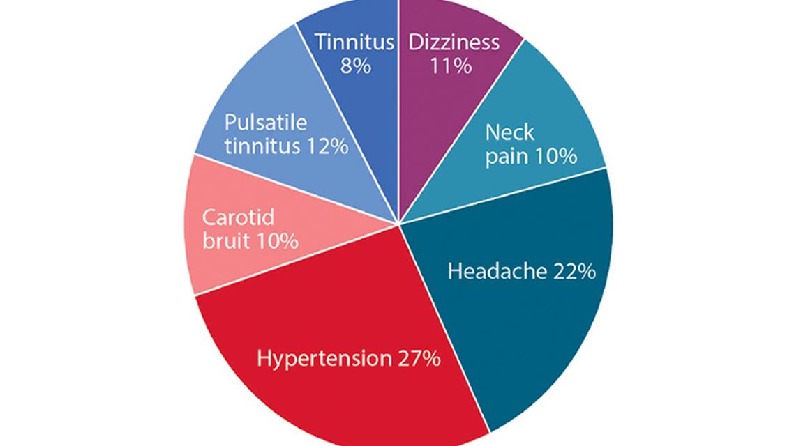Fibromuscular Dysplasia and Stroke