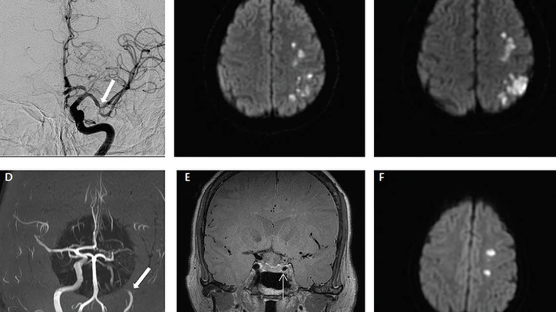 Infectious Causes of Stroke