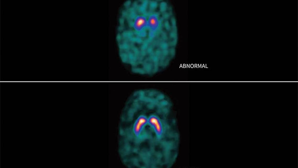 Updates in Diagnostic Testing in Parkinson Disease