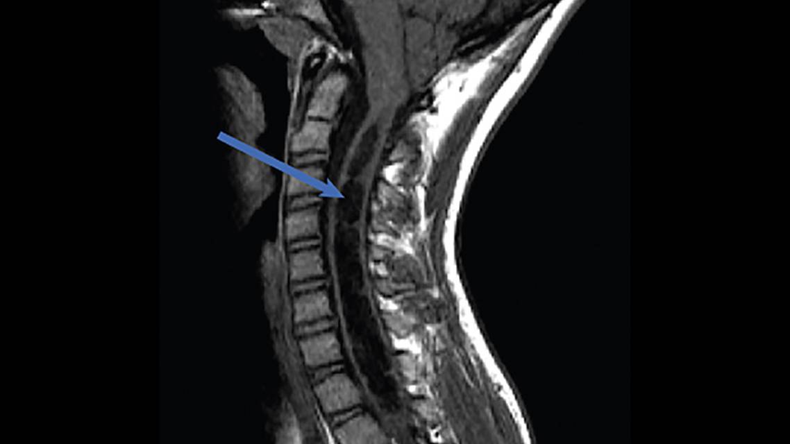 Understanding Chiari Malformation Comorbidities