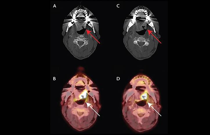 Glossopharyngeal Neuralgia