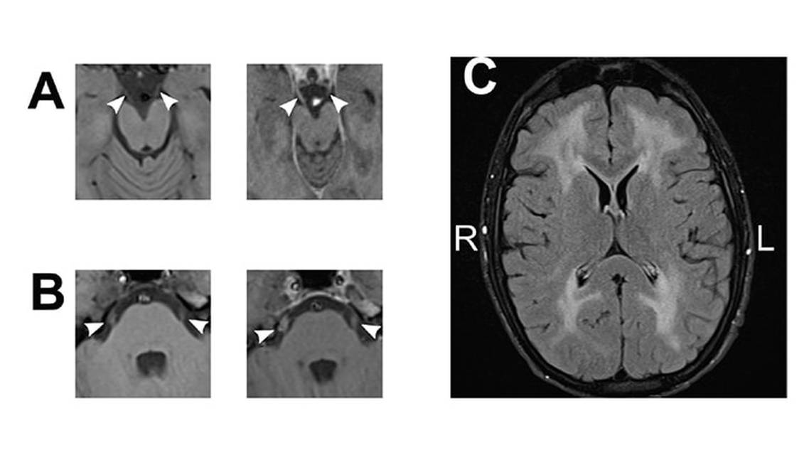 Case Reports Mitochondrial Neurogastrointestinal Encephalopathy