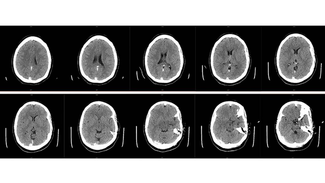 Management of Vein of Galen Thrombosis With Mechanical Thrombectomy