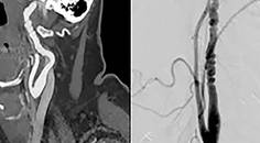 Challenge Case Report Increasing Frequency of Migraine
