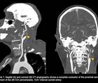Corpus Callosum StrokeA Rare Localization for an Isolated Cerebral Infarction