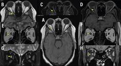 Neuro Ophthalmology Notions The Optic Nerve as Topographic Marker in the 2024 McDonald Diagnostic Criteria for Multiple Scle