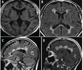 Radiologic Differential Diagnosis of Multiple Sclerosis - Practical ...