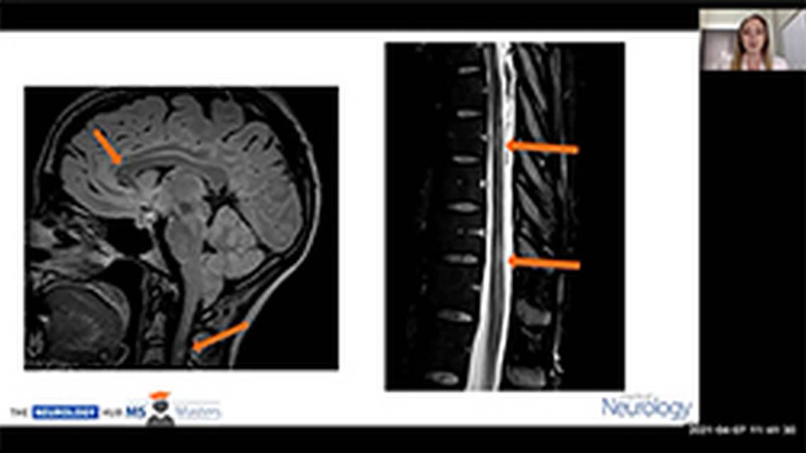 pregnancy and multiple sclerosis thumb new