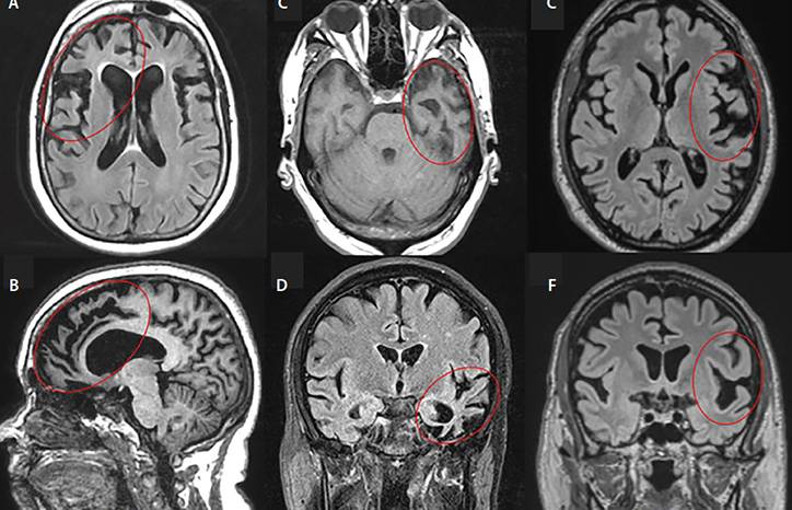 Frontotemporal Dementias