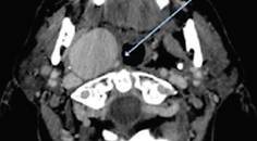 An Unusual Presentation of Syncope in a Patient With a Giant Cervical Carotid Aneurysm