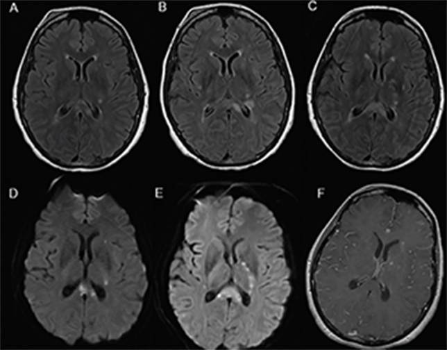 Case Challenge Recurrent Stroke Like Symptoms