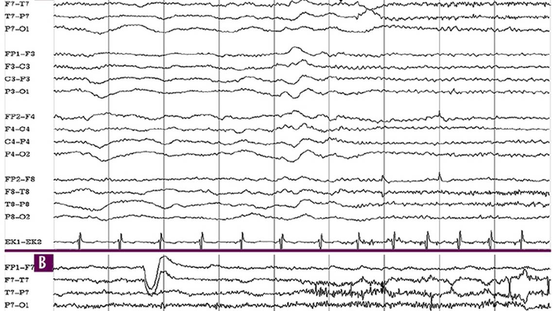 Epilepsy Essentials VideoEEG Analysis