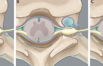Spontaneous Intracranial Hypotension