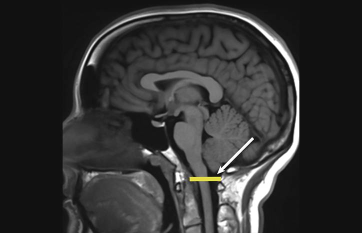 Understanding Chiari Malformations